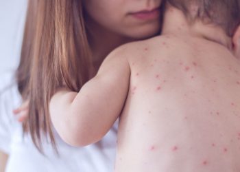 espana pierde estatus libre sarampion oms vacunacion triple virica