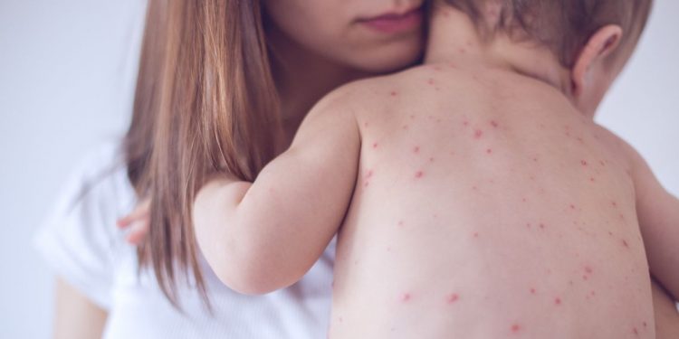 espana pierde estatus libre sarampion oms vacunacion triple virica